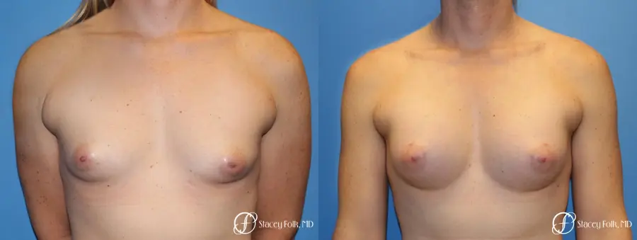 Denver Male to female top surgery with Sientra anatomic textured classic implants 5256 - Before and After 1