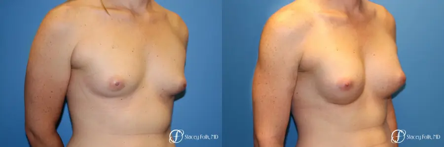 Denver Male to female top surgery with Sientra anatomic textured classic implants 5256 - Before and After 3