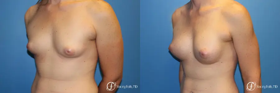 Denver Male to female top surgery with Sientra anatomic textured classic implants 5256 - Before and After 2
