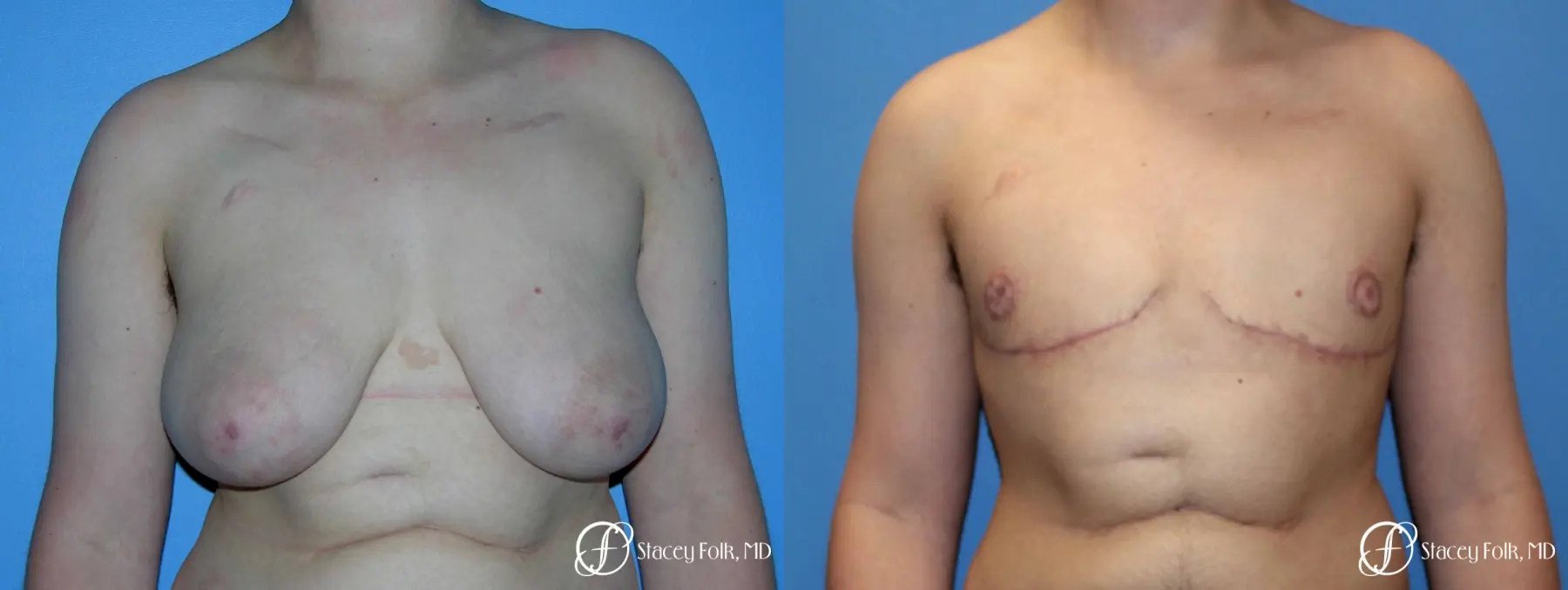 Denver Female to Male Top Surgery 5257 - Before and After