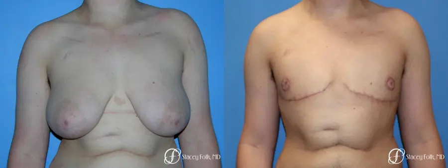 Denver Female to Male Top Surgery 5257 - Before and After 1