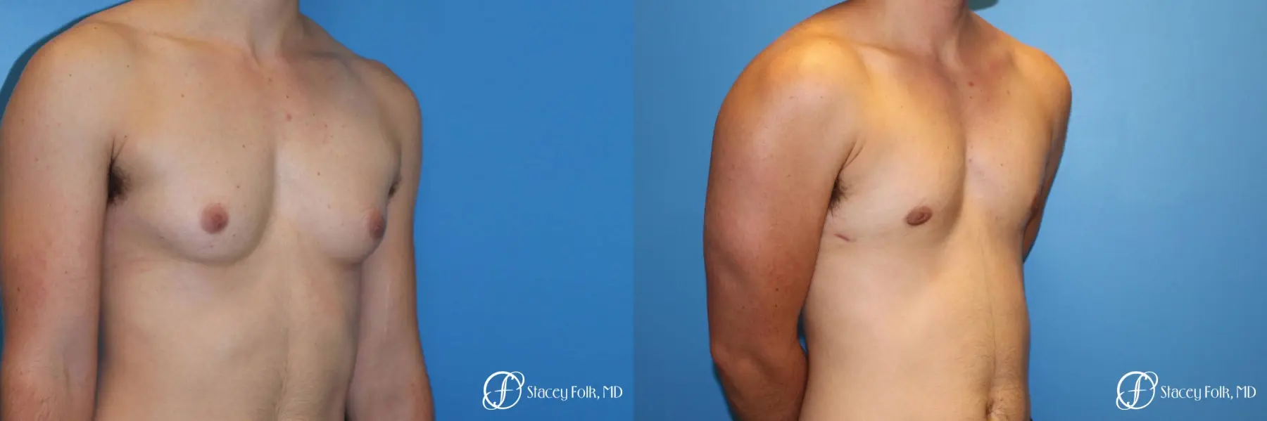 Denver FTM female to male top surgery using gynecomastia technique 5128 - Before and After 2