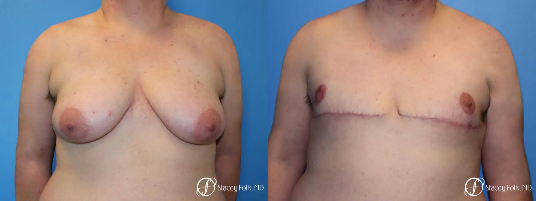 Denver FTM Female to male top surgery 5253 - Before and After