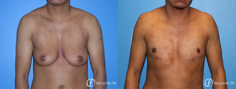 Denver FTM Female to male top surgery 5254 - Before and After 1