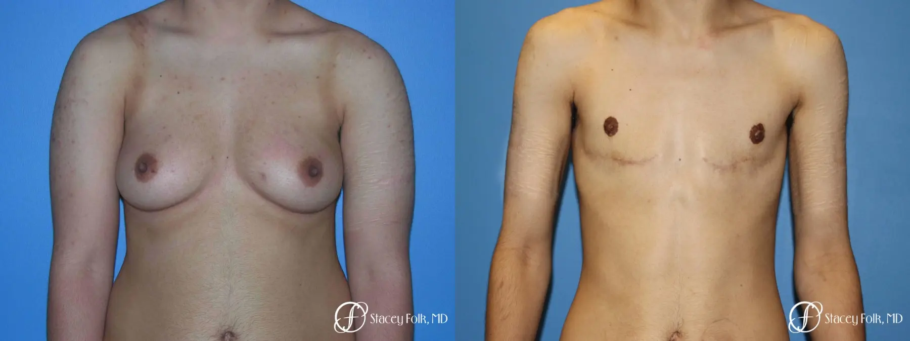 Denver FTM Female to male top surgery 5105 - Before and After