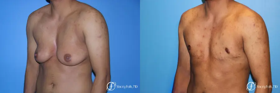 Denver FTM Female to male top surgery 5254 - Before and After 4