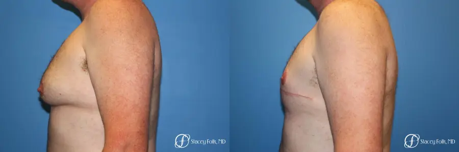Denver FTM Female to Male Top Surgery 7109 - Before and After 3