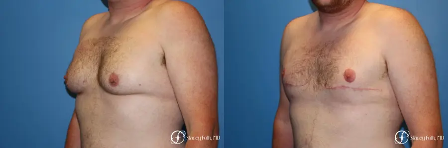 Denver FTM Female to Male Top Surgery 7109 - Before and After 2