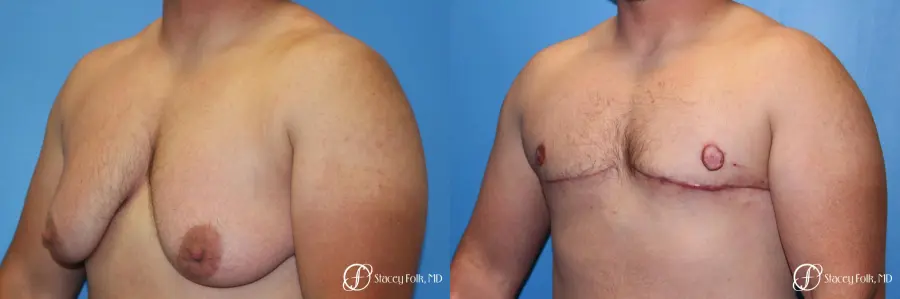 Denver FTM Female to male top surgery 5252 - Before and After 4