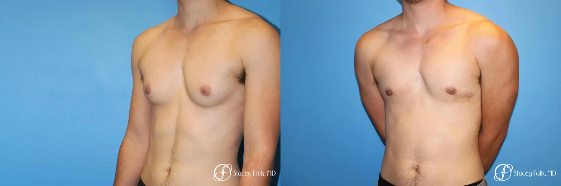 Denver FTM female to male top surgery using gynecomastia technique 5128 - Before and After 3