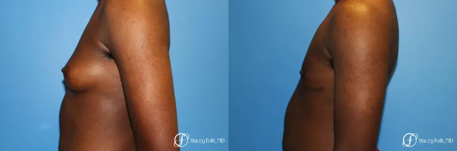 Denver FTM Female to male top surgery using gynecomastia technique 5497 - Before and After 3