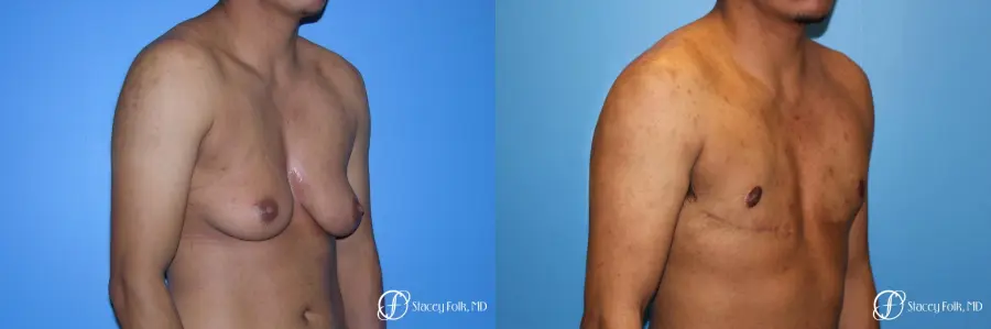 Denver FTM Female to male top surgery 5254 - Before and After 2