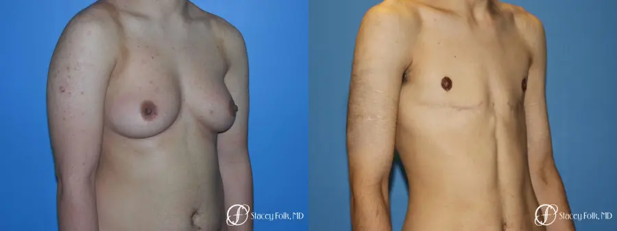 Denver FTM Female to male top surgery 5105 - Before and After 2