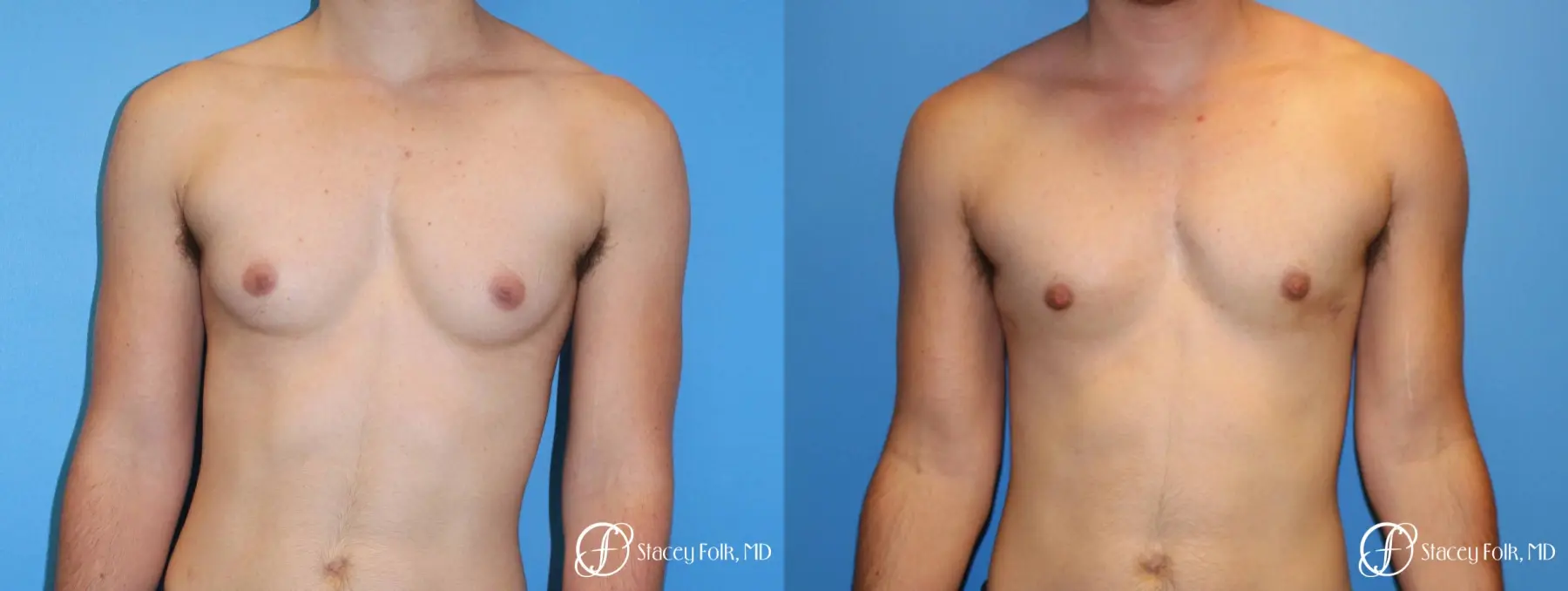 Denver FTM female to male top surgery using gynecomastia technique 5128 - Before and After 1