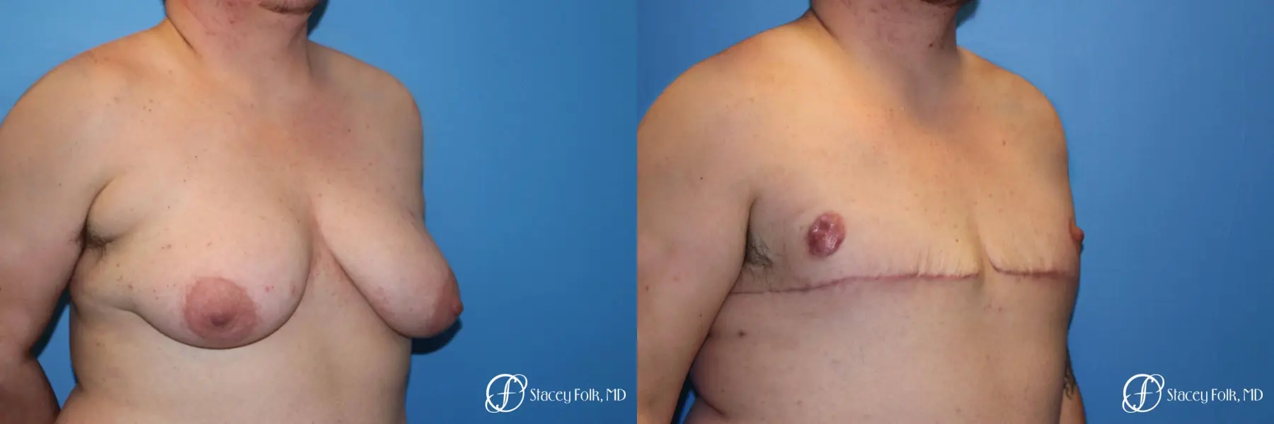 Denver FTM Female to male top surgery 5253 - Before and After 2