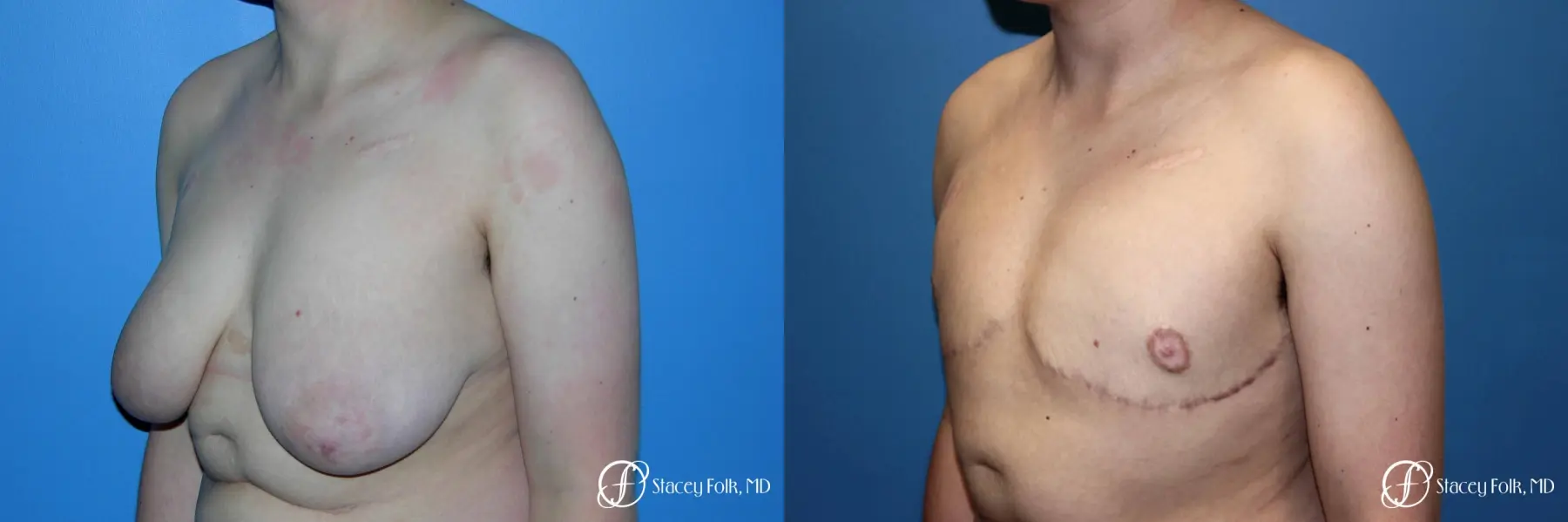 Denver Female to Male Top Surgery 5257 - Before and After 4