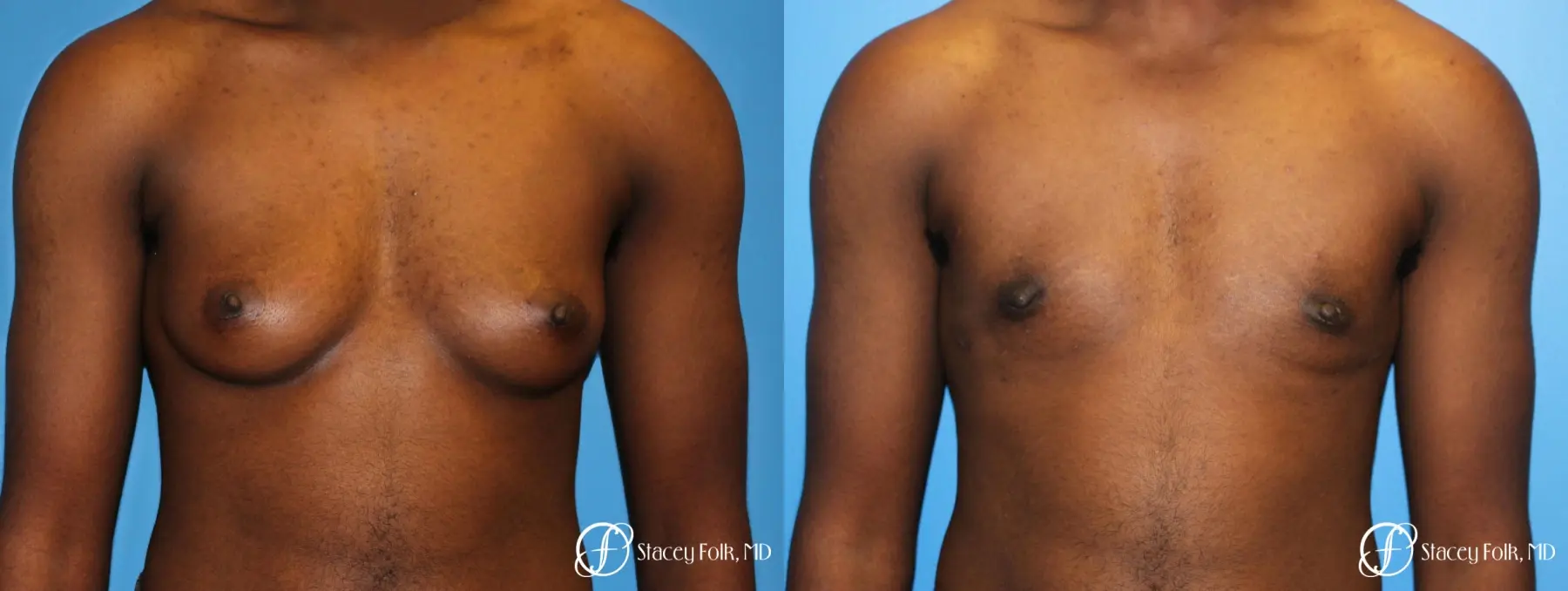 Denver FTM Female to male top surgery using gynecomastia technique 5497 - Before and After 1