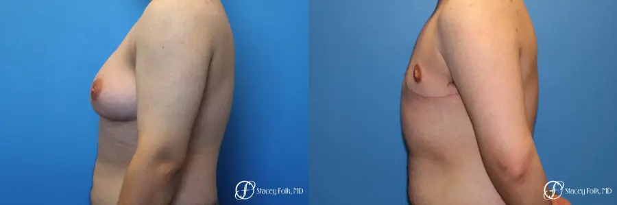 Denver FTM Top Surgery 5089 - Before and After 2