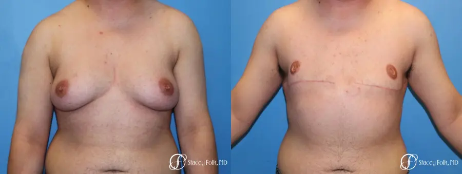 Denver FTM Top Surgery 5089 - Before and After 1