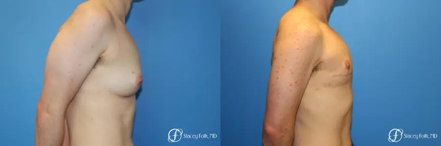 Denver FTM Female to male top surgery 6608 - Before and After 2