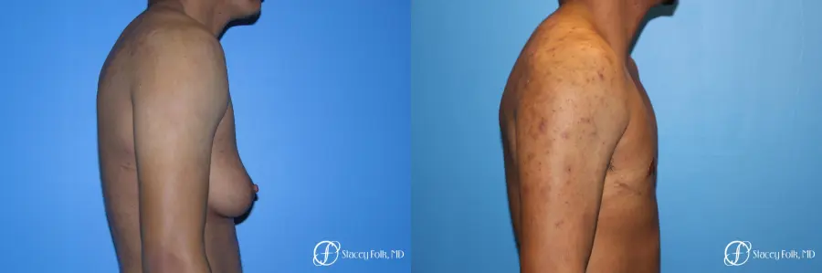 Denver FTM Female to male top surgery 5254 - Before and After 3