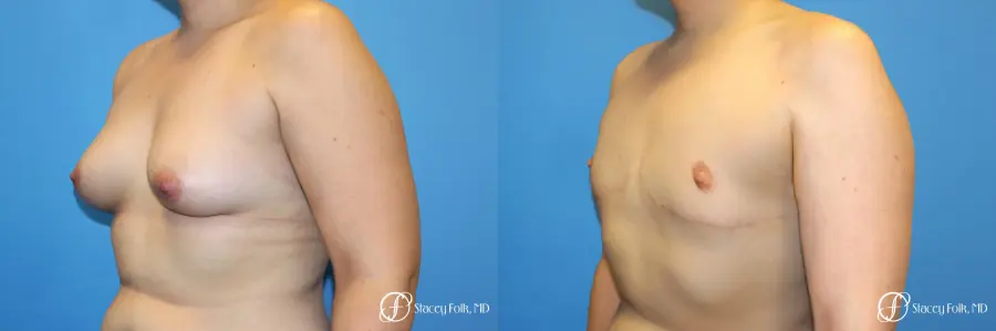 Denver FTM Top Surgery 5088 - Before and After 2