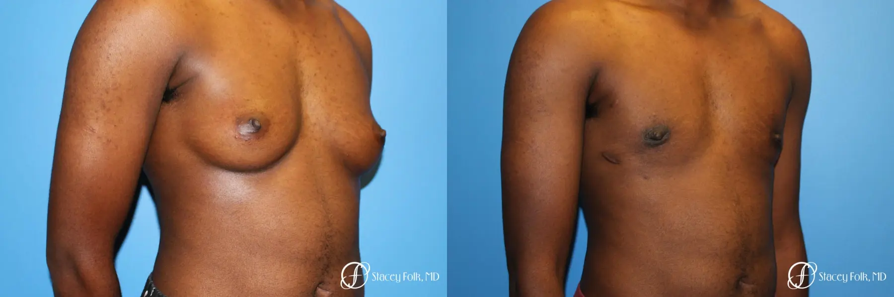 Denver FTM Female to male top surgery using gynecomastia technique 5497 - Before and After 2