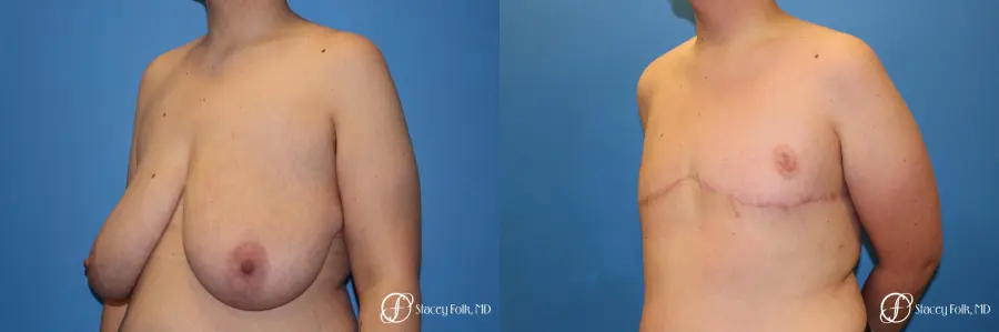 Denver FTM Female to male top surgery 5255 - Before and After 4