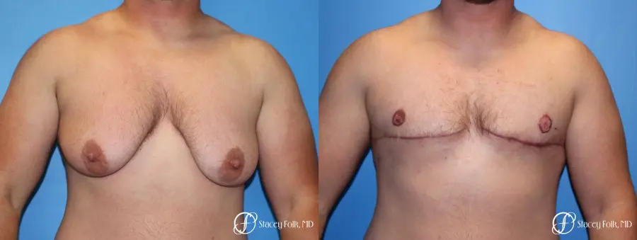 Denver FTM Female to male top surgery 5252 - Before and After 1