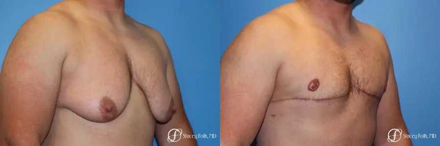 Denver FTM Female to male top surgery 5252 - Before and After 2