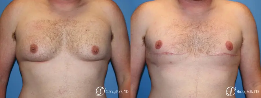 Denver FTM Female to Male Top Surgery 7109 - Before and After 1