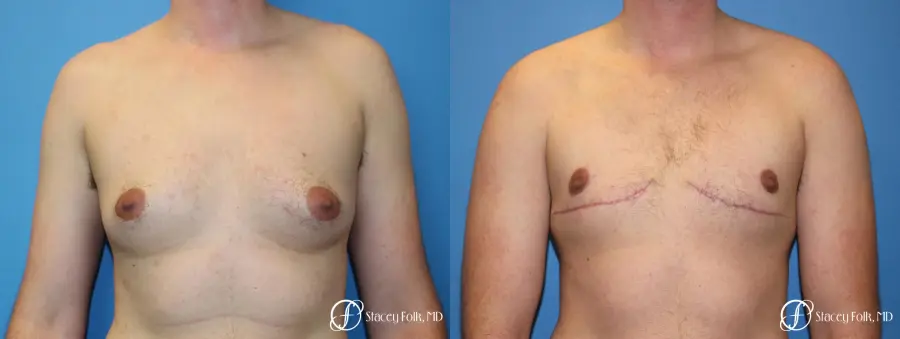 Denver FTM Female to Male Top Surgery 7708 - Before and After 1
