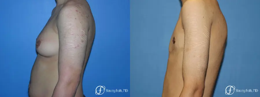 Denver FTM Female to male top surgery 5105 - Before and After 3