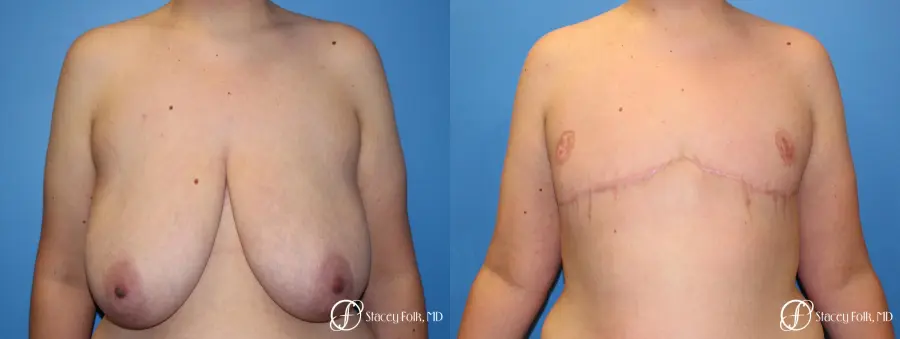 Denver FTM Female to male top surgery 5255 - Before and After 1