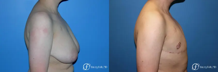 Denver Female to Male Top Surgery 5257 - Before and After 3