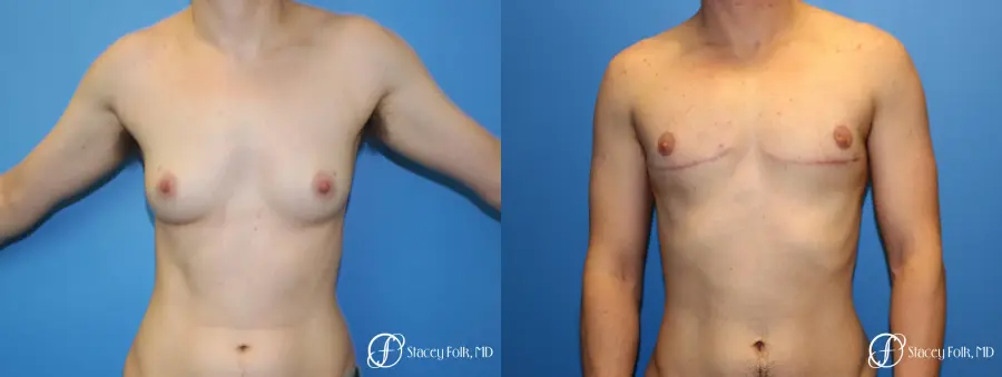 Denver FTM Female to male top surgery 6608 - Before and After