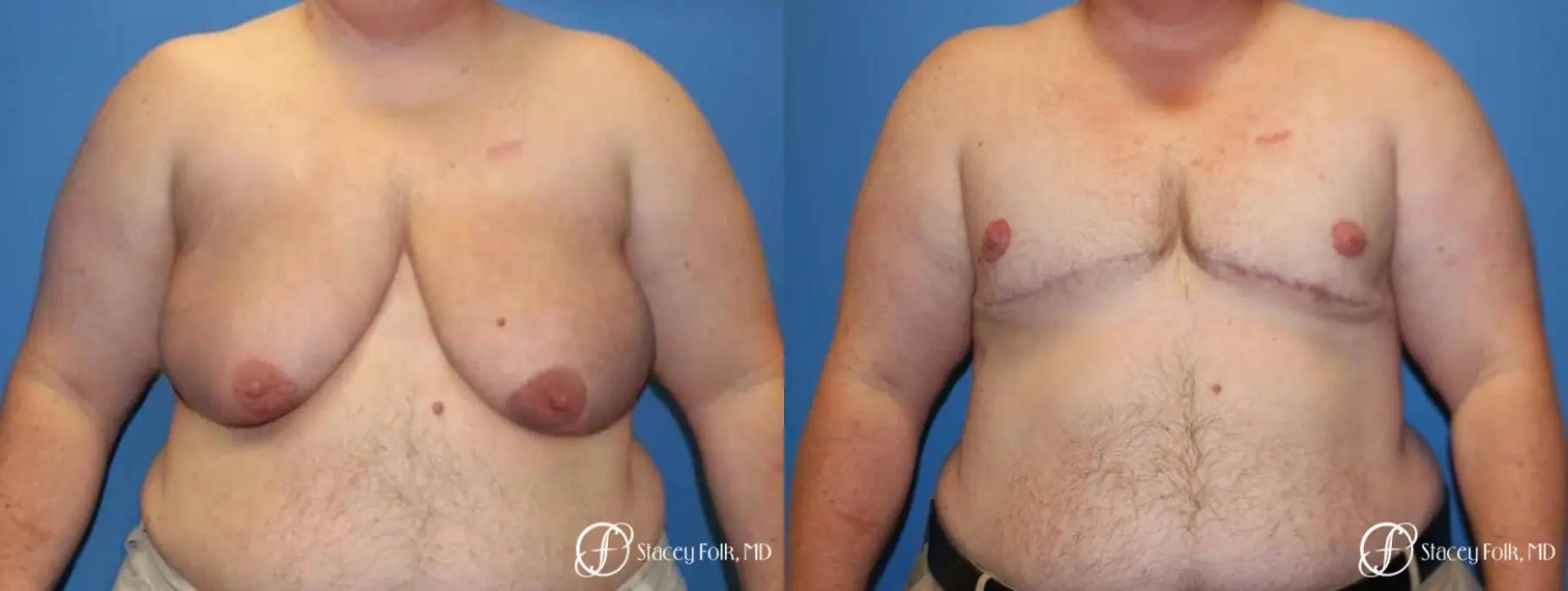 Denver Female to male top surgery 5258 - Before and After 1