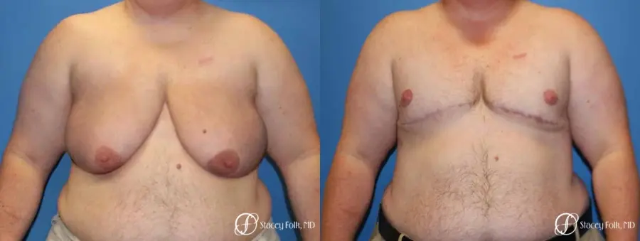 Denver Female to male top surgery 5258 - Before and After 1