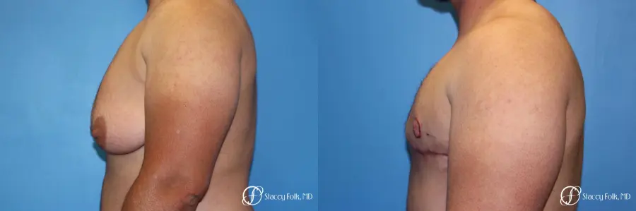 Denver FTM Female to male top surgery 5252 - Before and After 5