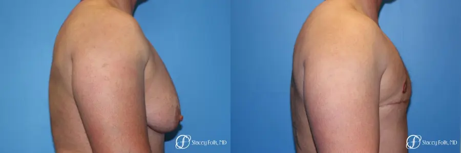 Denver FTM Female to male top surgery 5252 - Before and After 3
