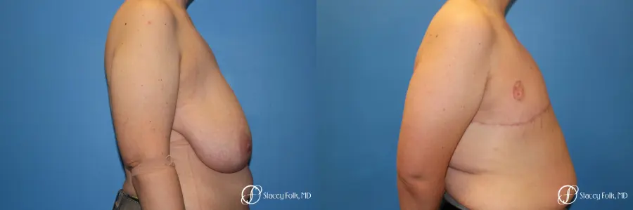 Denver FTM Female to male top surgery 5255 - Before and After 3