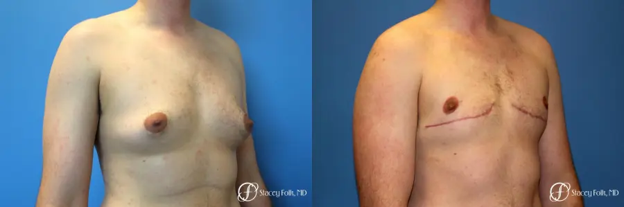 Denver FTM Female to Male Top Surgery 7708 - Before and After 2