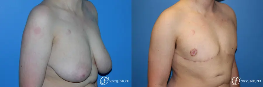 Denver Female to Male Top Surgery 5257 - Before and After 2