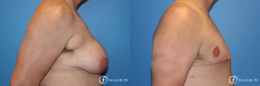 Denver FTM Female to male top surgery 5253 - Before and After 3