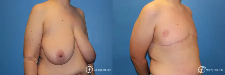 Denver FTM Female to male top surgery 5255 - Before and After 2