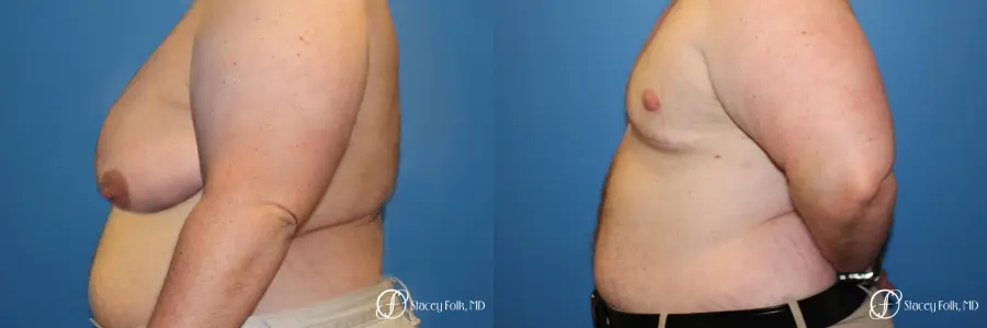 Denver Female to male top surgery 5258 - Before and After 2
