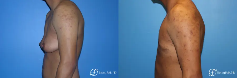 Denver FTM Female to male top surgery 5254 - Before and After 5