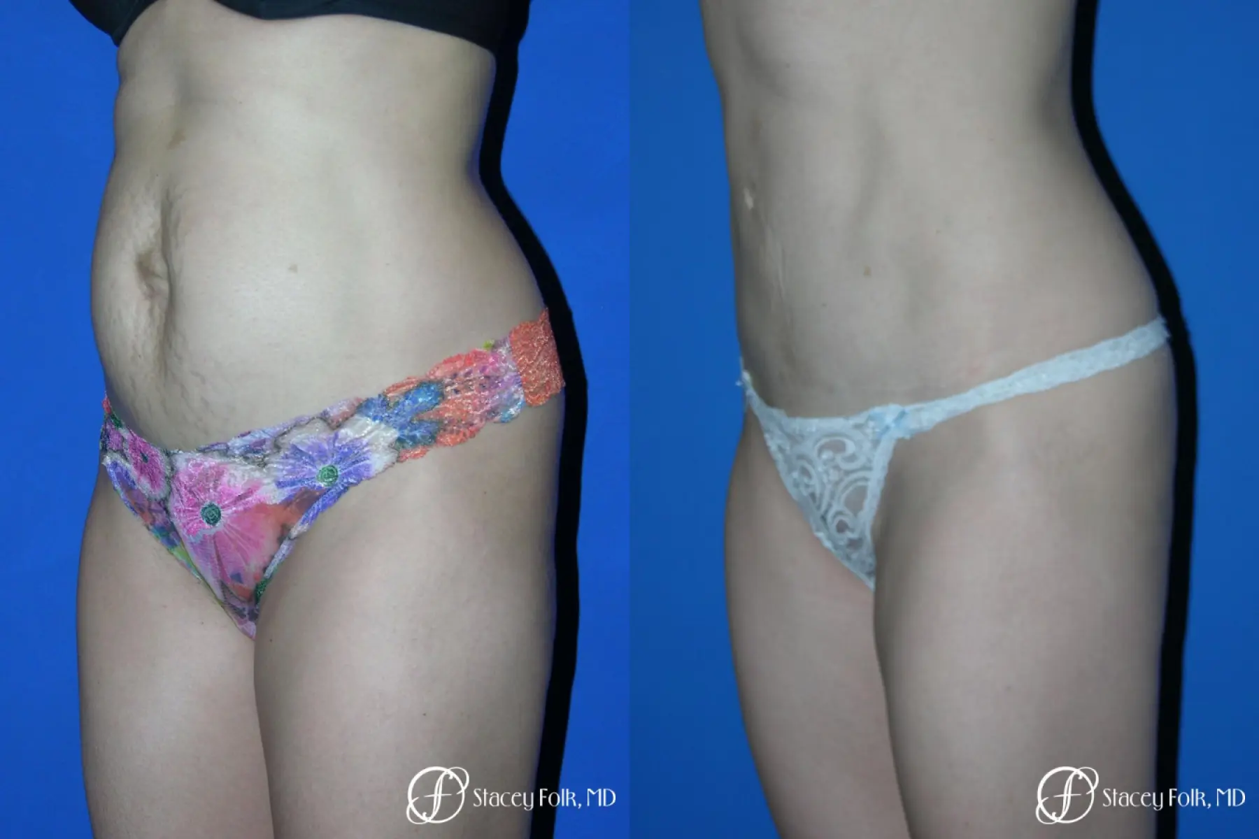 Denver Tummy Tuck Abdominoplasty 5456 - Before and After 2