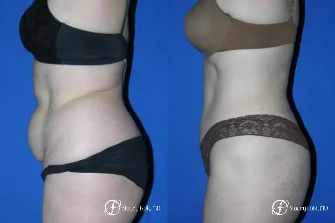Denver Tummy Tuck 44 - Before and After 3