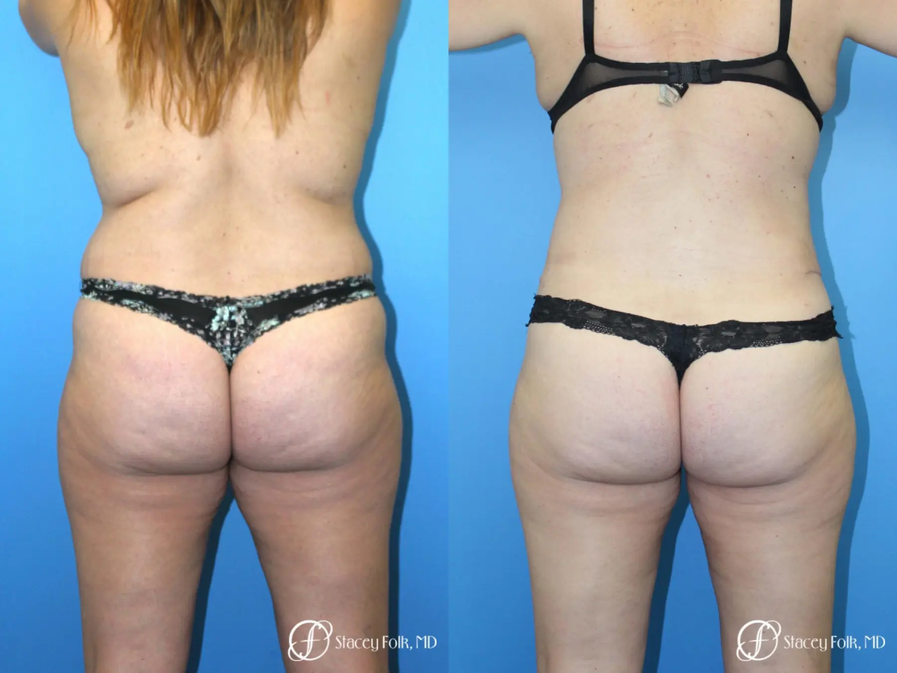 Tummy Tuck (Abdominoplasty) and Liposuction - Before and After 2